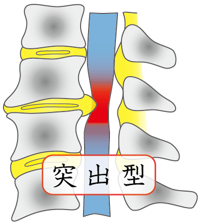 突出型ヘルニア