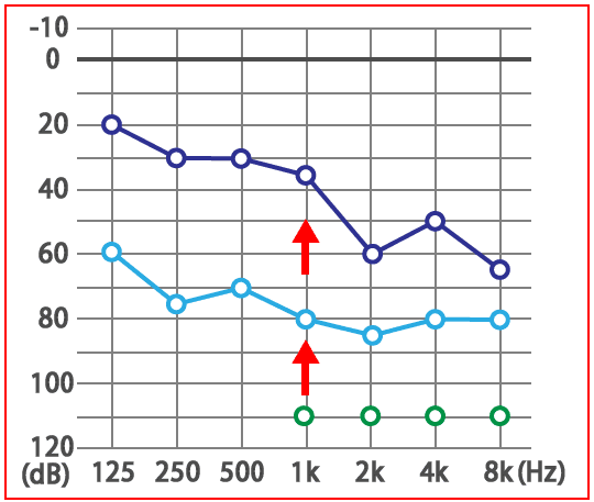 子供のムンプス難聴