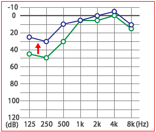 めまい・メニエール病・PPPD
