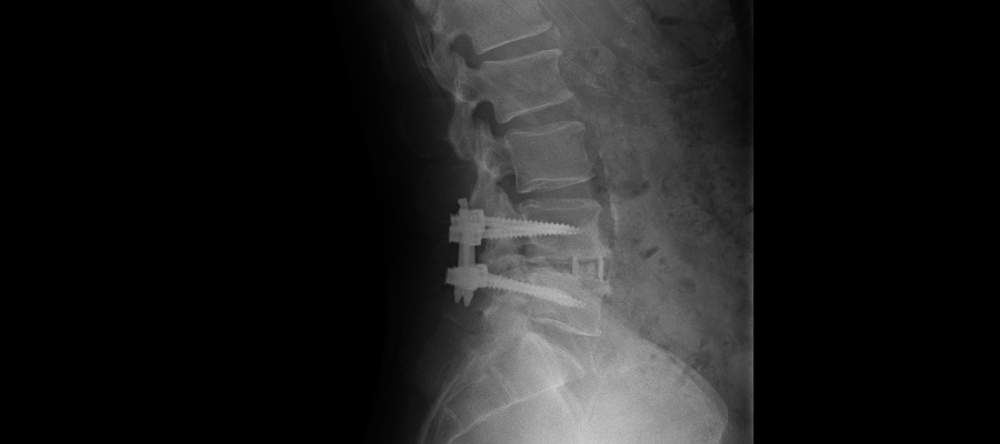 脊柱菅狭窄症の手術
