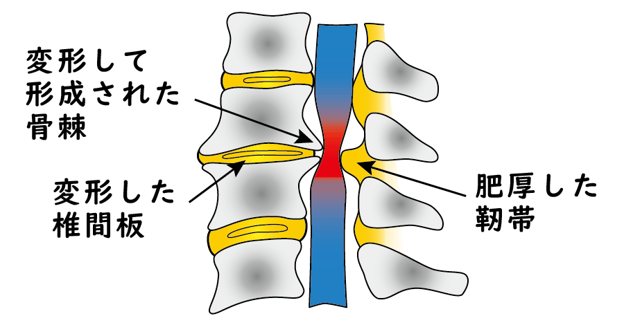 脊柱菅狭窄症の治療