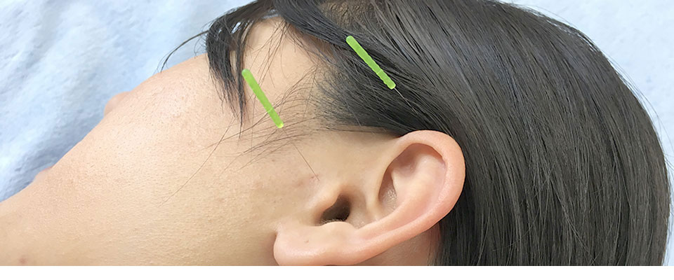 めまい・メニエール病・PPPD