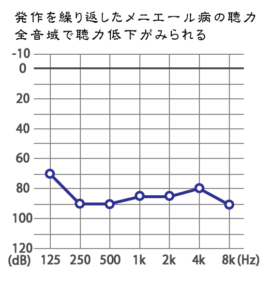 メニエール病：難聴の聴力水平型